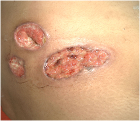 Pyoderma